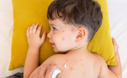 Geluri calmante pentru înțepăturile de insecte: ghid practic cu soluții eficiente și naturale