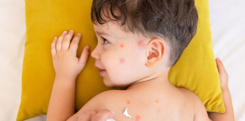 Geluri calmante pentru înțepăturile de insecte: ghid practic cu soluții eficiente și naturale